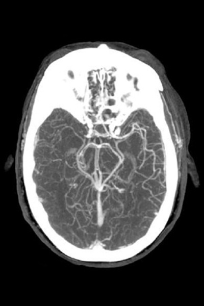 CT Angiography