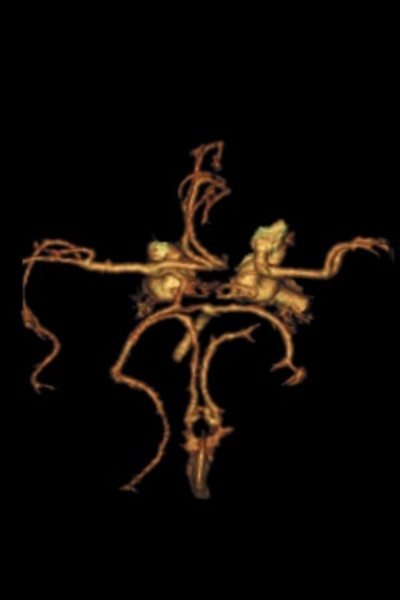 Circle of Willis