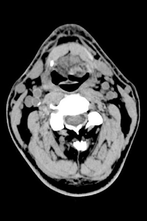 Neck and Cervical Spine