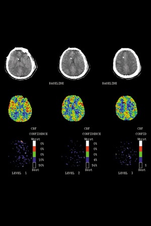 Perfusion Color Maps