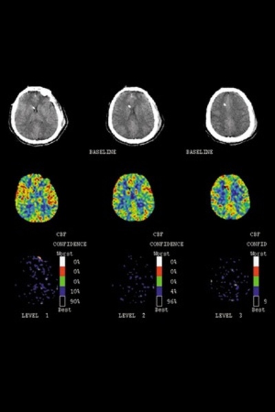Perfusion Color Maps