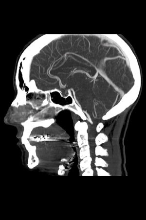 Sagittal MIP CTA