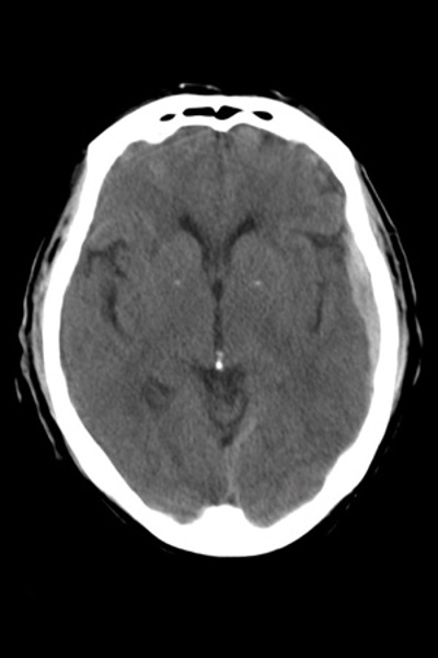 Subdural Bleed