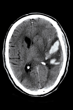 Subdural Bleed