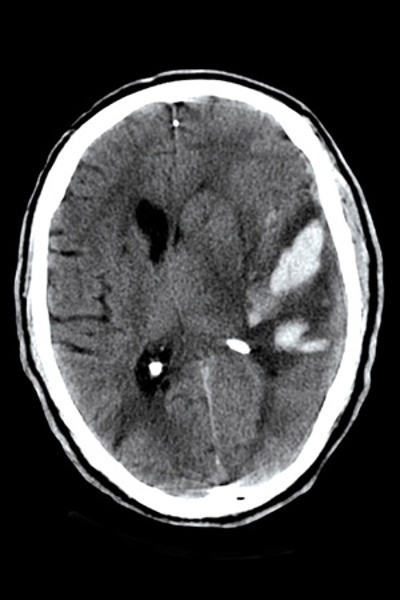 Subdural Bleed