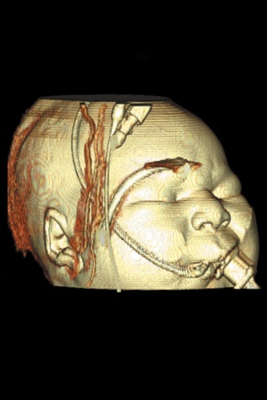 3D Ventilated Patient