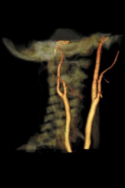 CTA Carotid Arteries