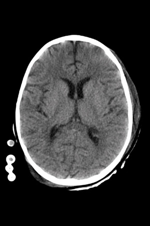 Gray/White Differentiation in Pediatric Brain