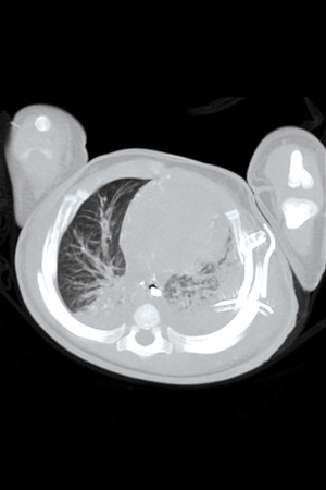 MIP Pediatric Lung