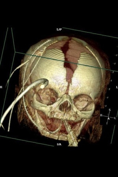 3D Ventilated Neonate