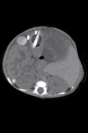 Pediatric Abdomen with Shunt