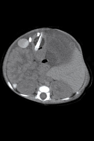 Pediatric Abdomen with Shunt