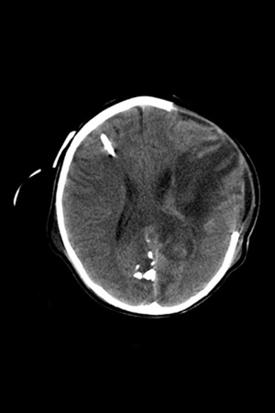 Post-op Shunt and Bleed