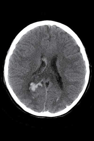 Subdural Bleed