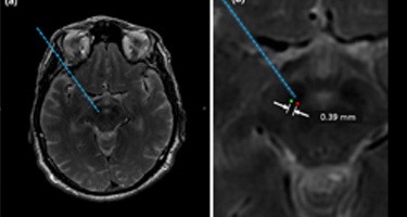 Electrode Placement Accuracy in Robot-Assisted Asleep Deep Brain Stimulation